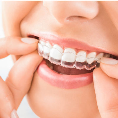  Ortodoncia rápida/invisible