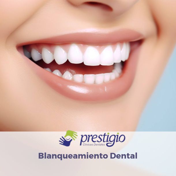 Tratamientos de Blanqueamiento Dental con Prestigio Dental